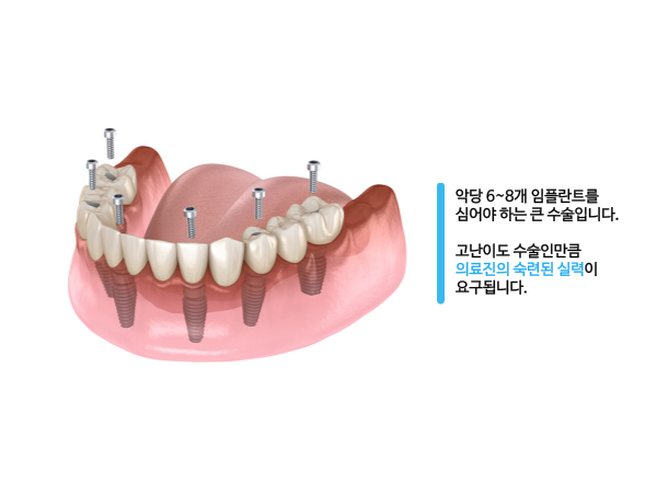 전체 임플란트