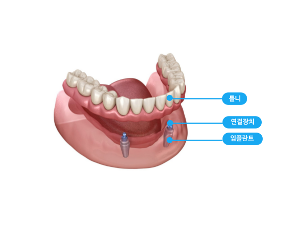 임플란트 지지 틀니