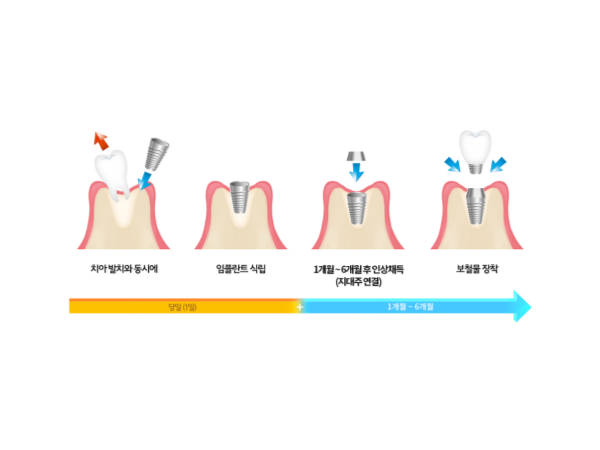 발치즉시임플란트
