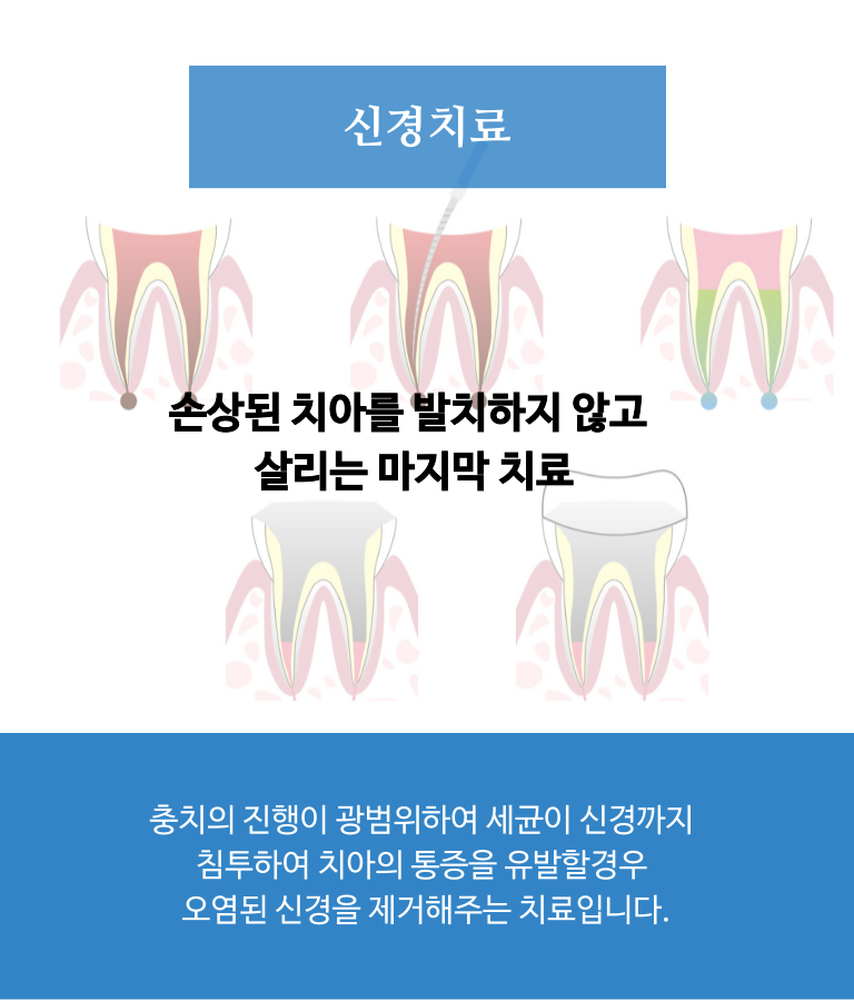 신경치료