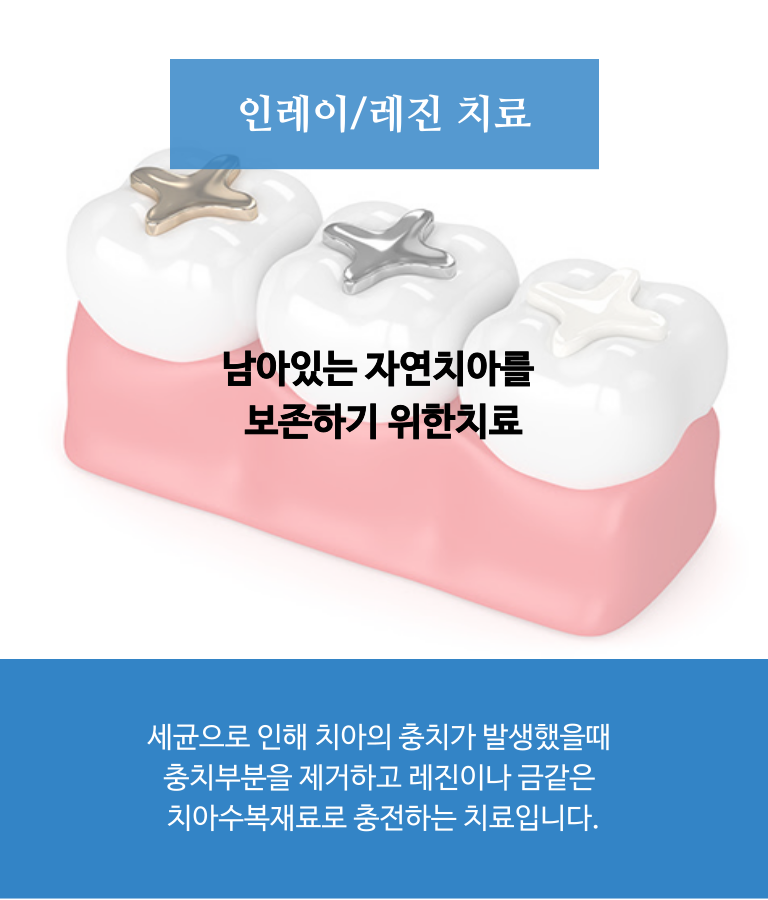 인레이/레진 치료